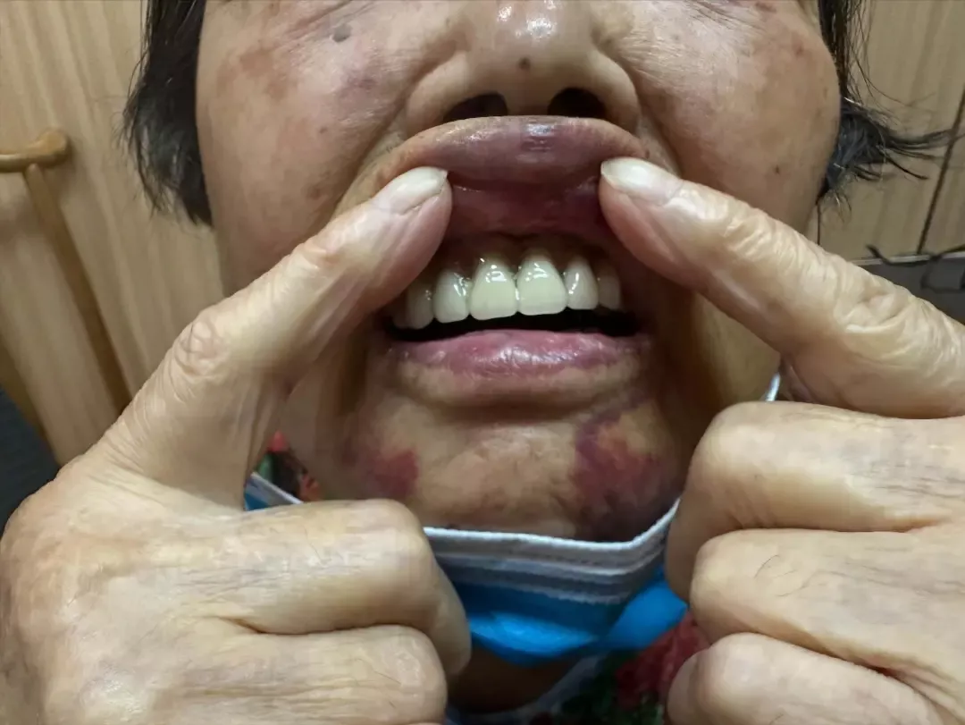芦女士的面部人中、下巴仍有多处青紫淤血,上唇要用手辅助才能拨开