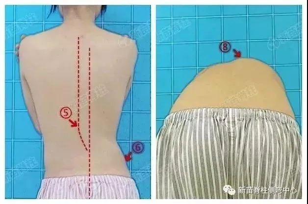 确诊脊柱侧弯之后:努力被扳正的青少年