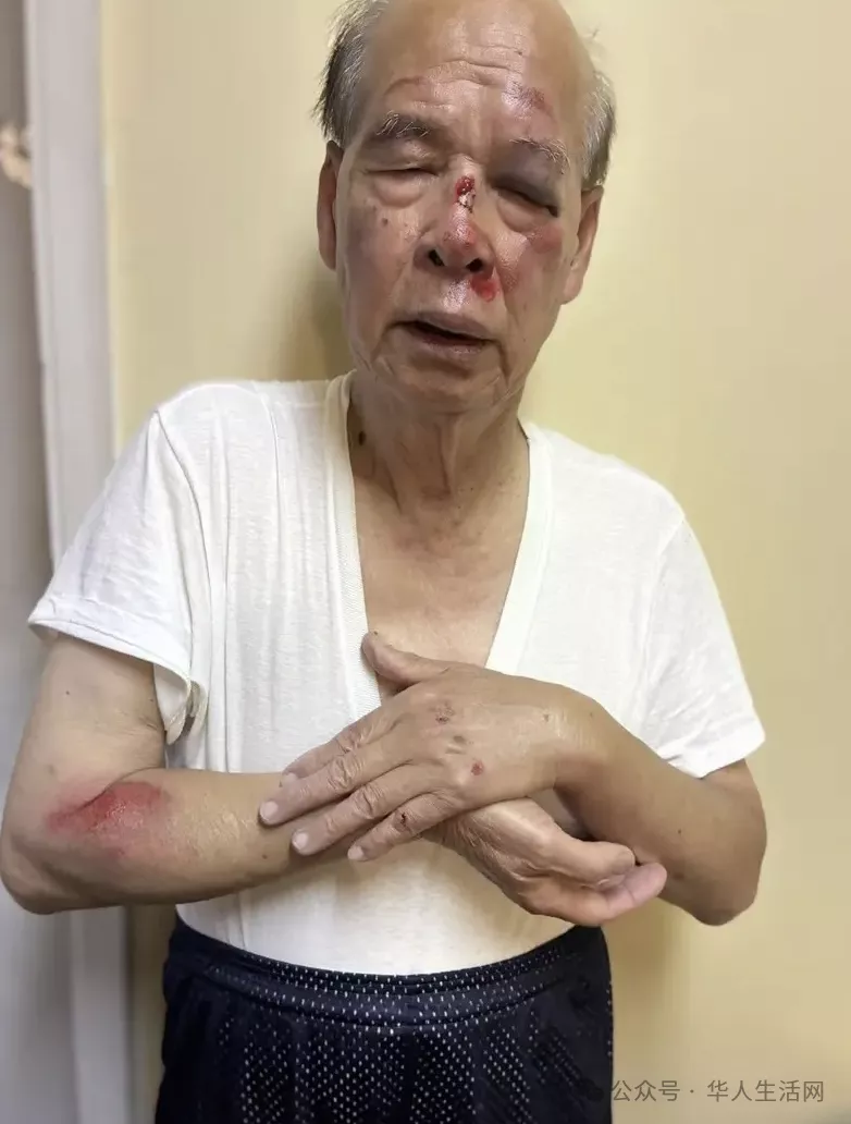 93岁知名侨领被女贼抢劫拖行!南加治安再亮红灯