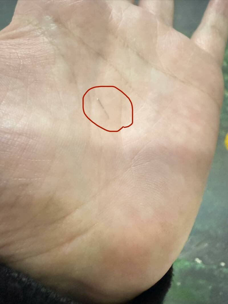 谢女发现罪魁祸首是根针头,她赶紧就医不敢大意。(翻摄自谢女threads) 谢女发现罪魁祸首是根针头,她赶紧就医不敢大意。(翻摄自谢女threads)