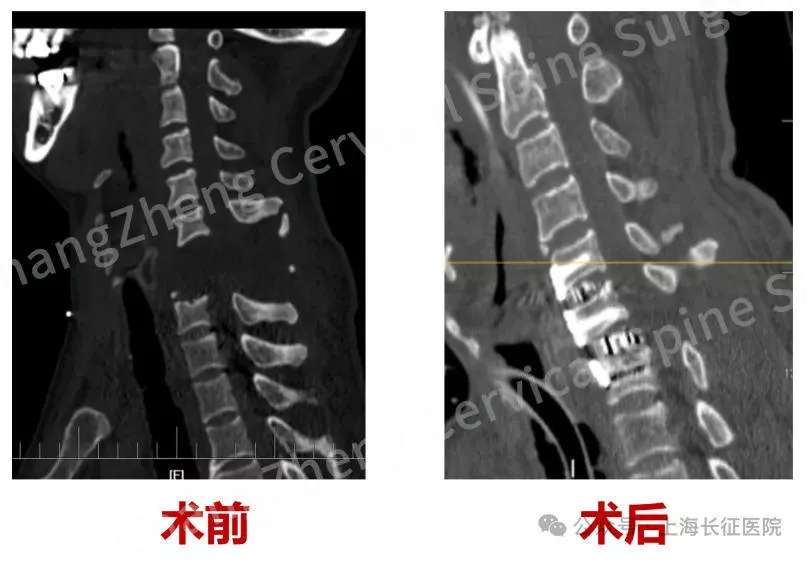 全球罕见！“身首离断”患者被救回