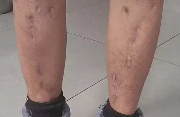 戴浩腿上术后留下的疤痕 (受访者提供)