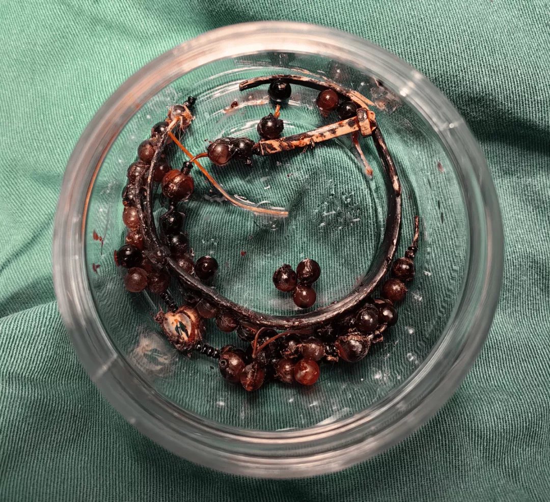 33岁女子戴手镯10年不摘,长胖后嵌进肉里