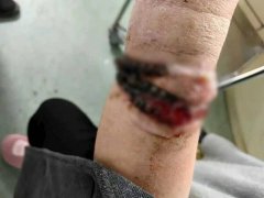 10年没拔！手镯「长进肉里」化脓飘恶臭 中国女险截肢
