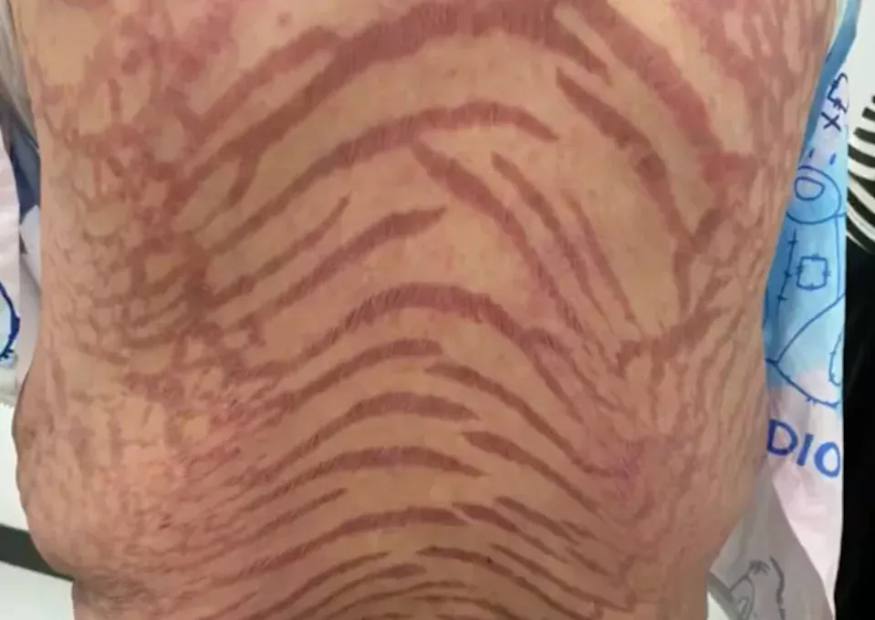 号称治百病！40岁女狂擦“网红神药”全身布满蛇纹 医师揭惊人成分