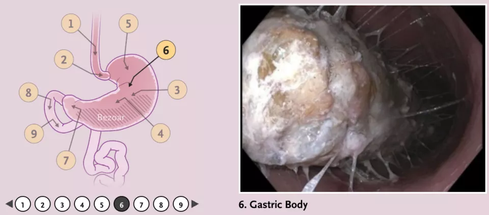 网红神药,让她减重36斤后胃里长出“石头”
