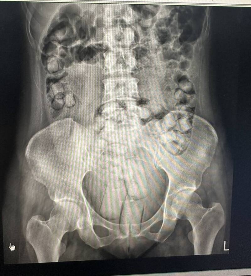 泰籍女子体内夹藏大大小小毒品。（海巡署提供）